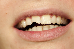 dental care for broken teeth in rochester ny